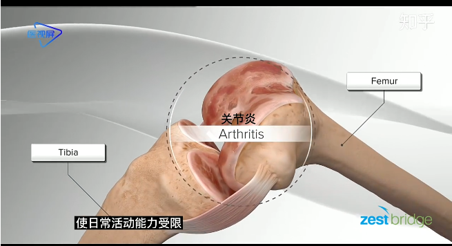 人工膝蓋置換術(shù)3D動(dòng)畫(huà)示意圖