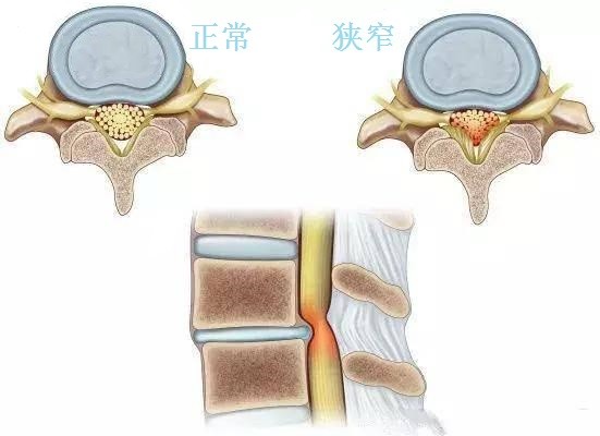 狹窄.jfif